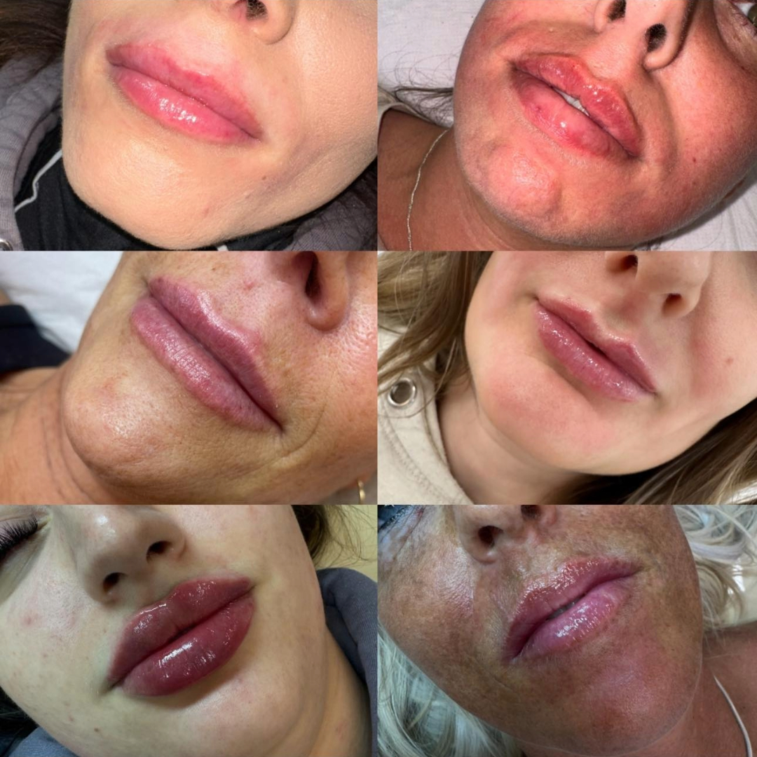 Lip enhancements near me Lip enhancements near me