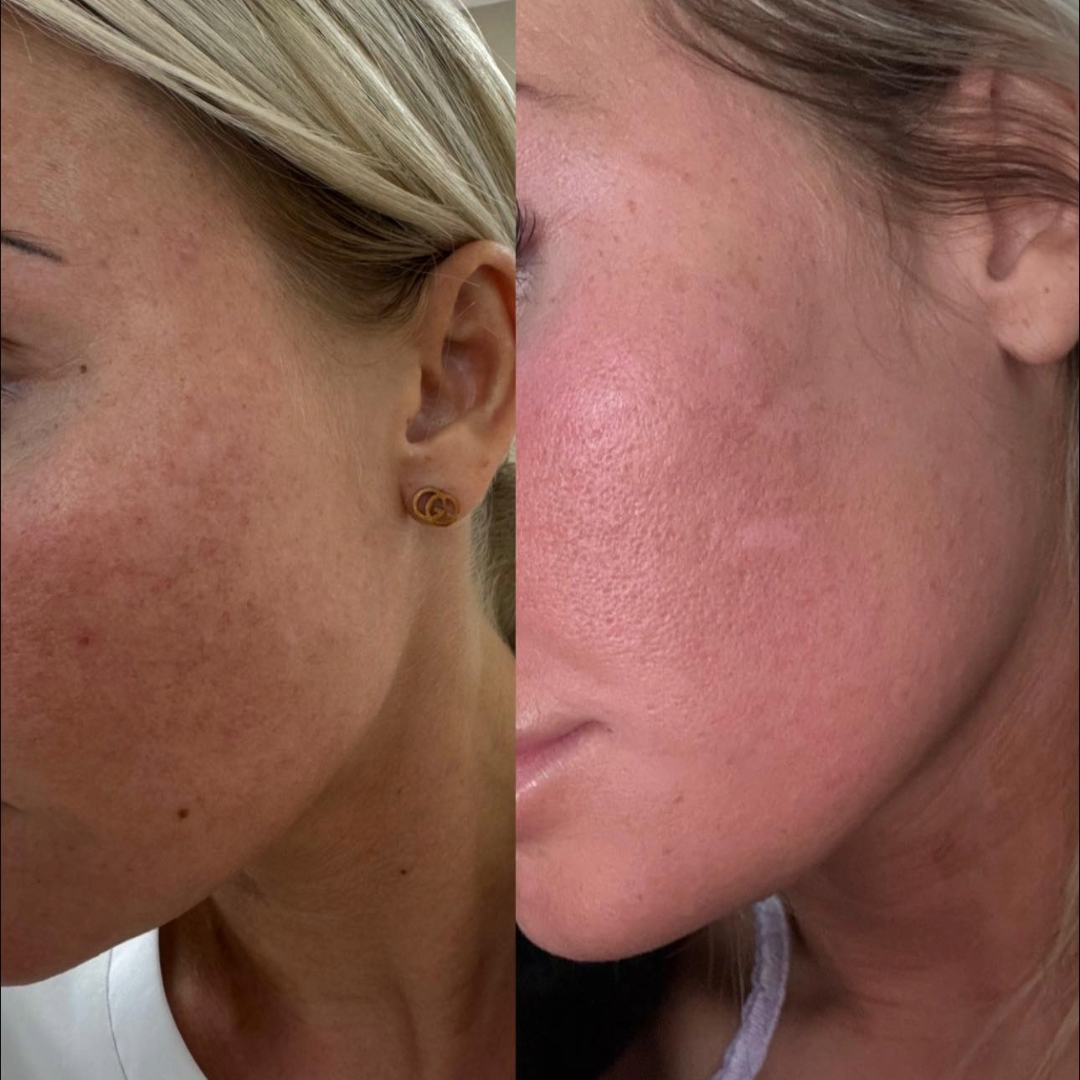 skin boosters at the salon durham skin boosters at the salon durham