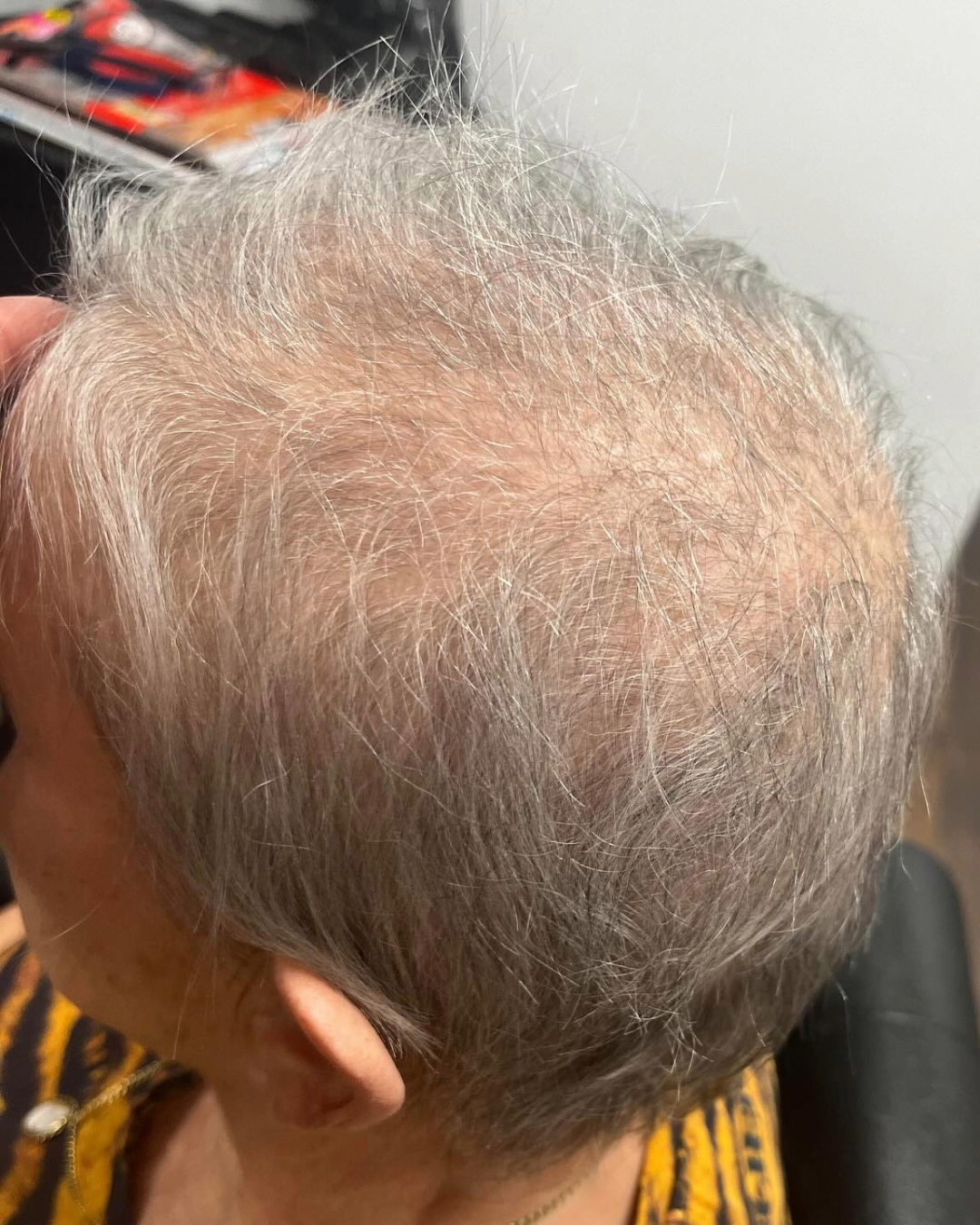 Novo Cabelo Hair Replacement Langley Park Hairdressers Novo Cabelo Hair Replacement Langley Park Hairdressers